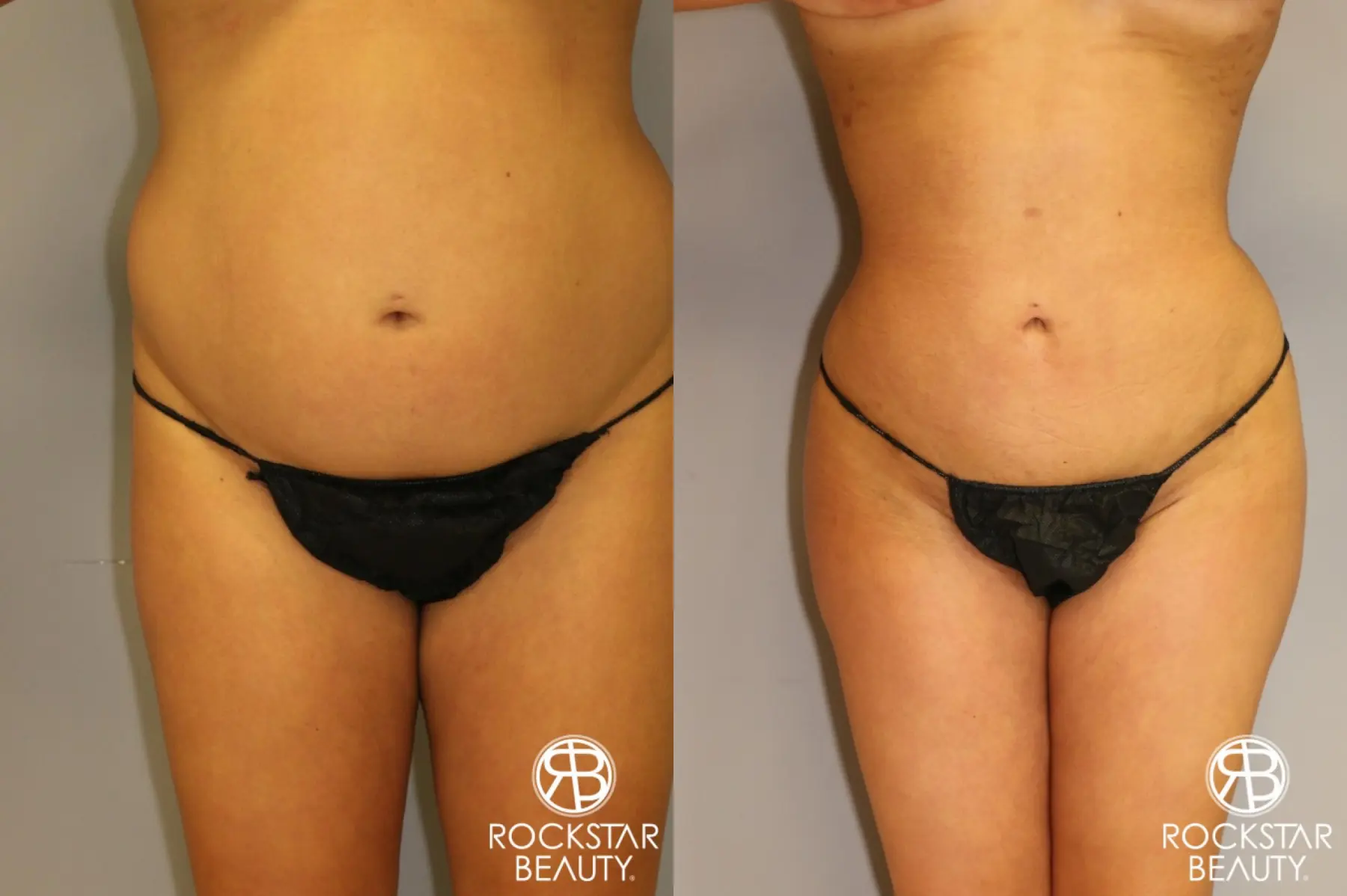 Brazilian Butt Lift: Patient 1 - Before and After 2