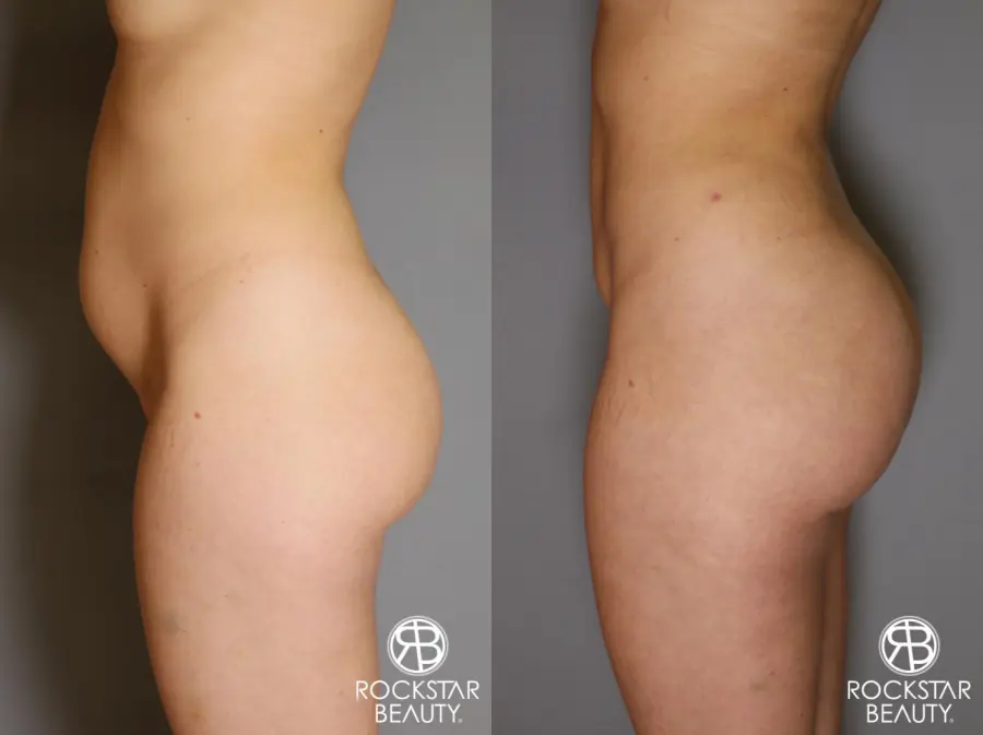 Brazilian Butt Lift: Patient 18 - Before and After 2