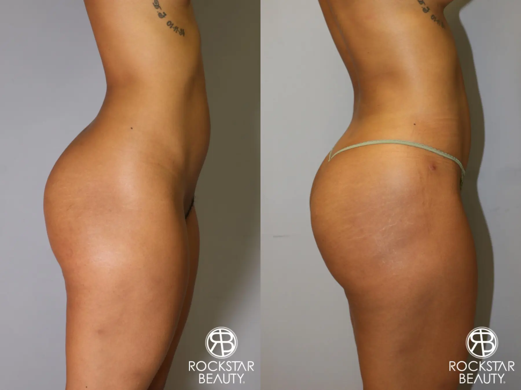 Brazilian Butt Lift: Patient 8 - Before and After 2