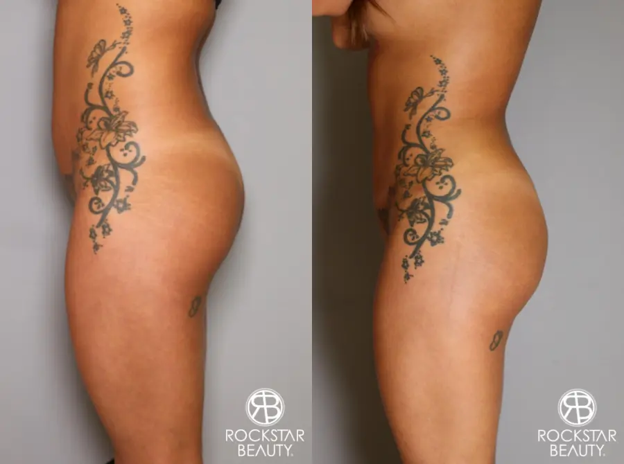 Brazilian Butt Lift: Patient 9 - Before and After 3
