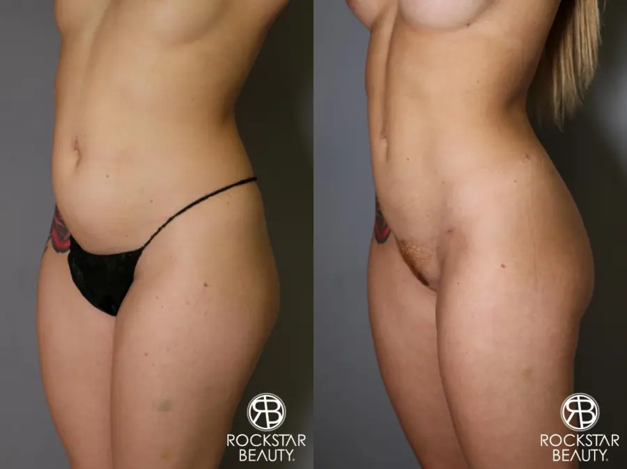 Brazilian Butt Lift: Patient 16 - Before and After 3