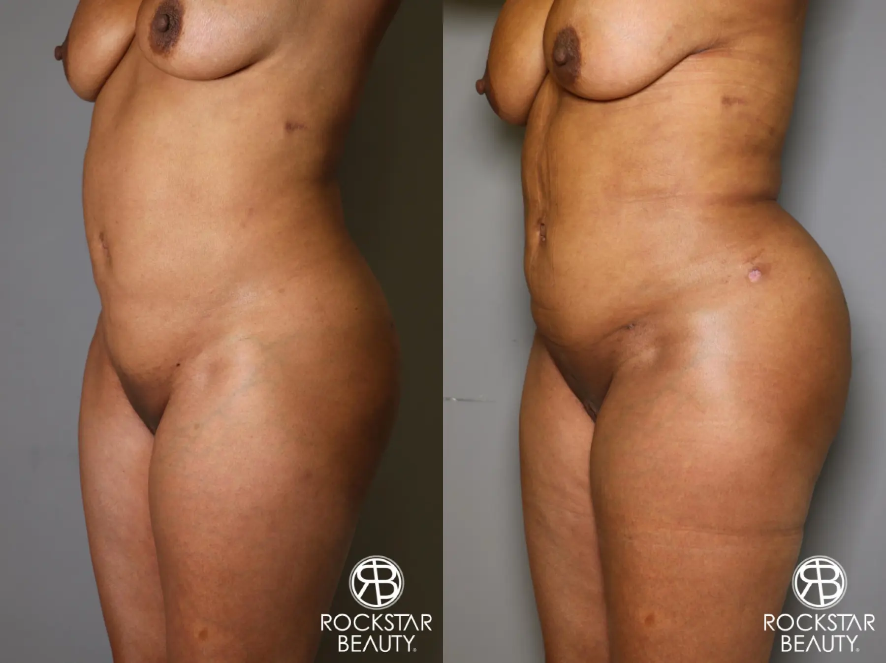 Brazilian Butt Lift: Patient 11 - Before and After 3