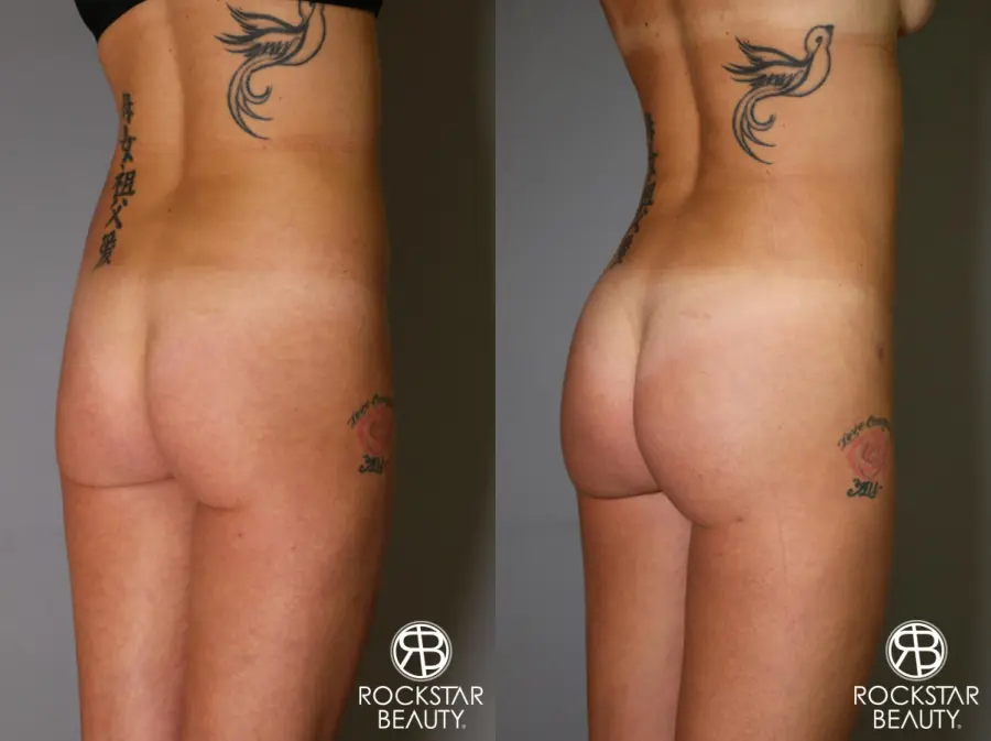 Brazilian Butt Lift: Patient 6 - Before and After 2