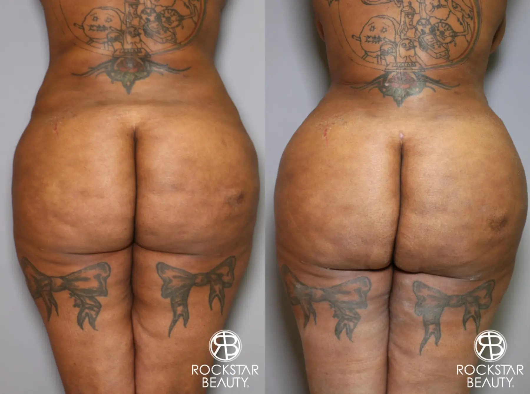 Brazilian Butt Lift: Patient 15 - Before and After 1