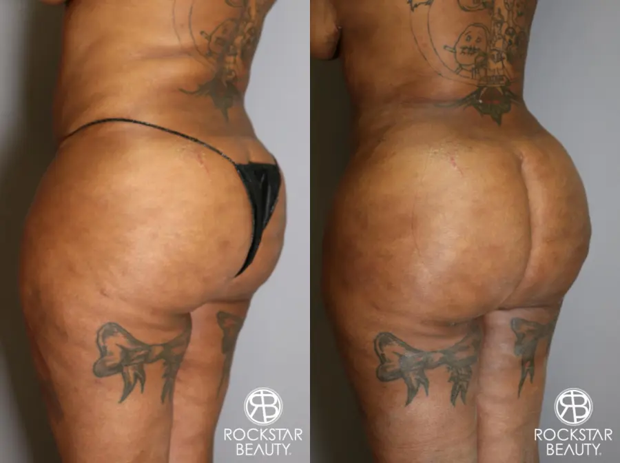 Brazilian Butt Lift: Patient 15 - Before and After 3