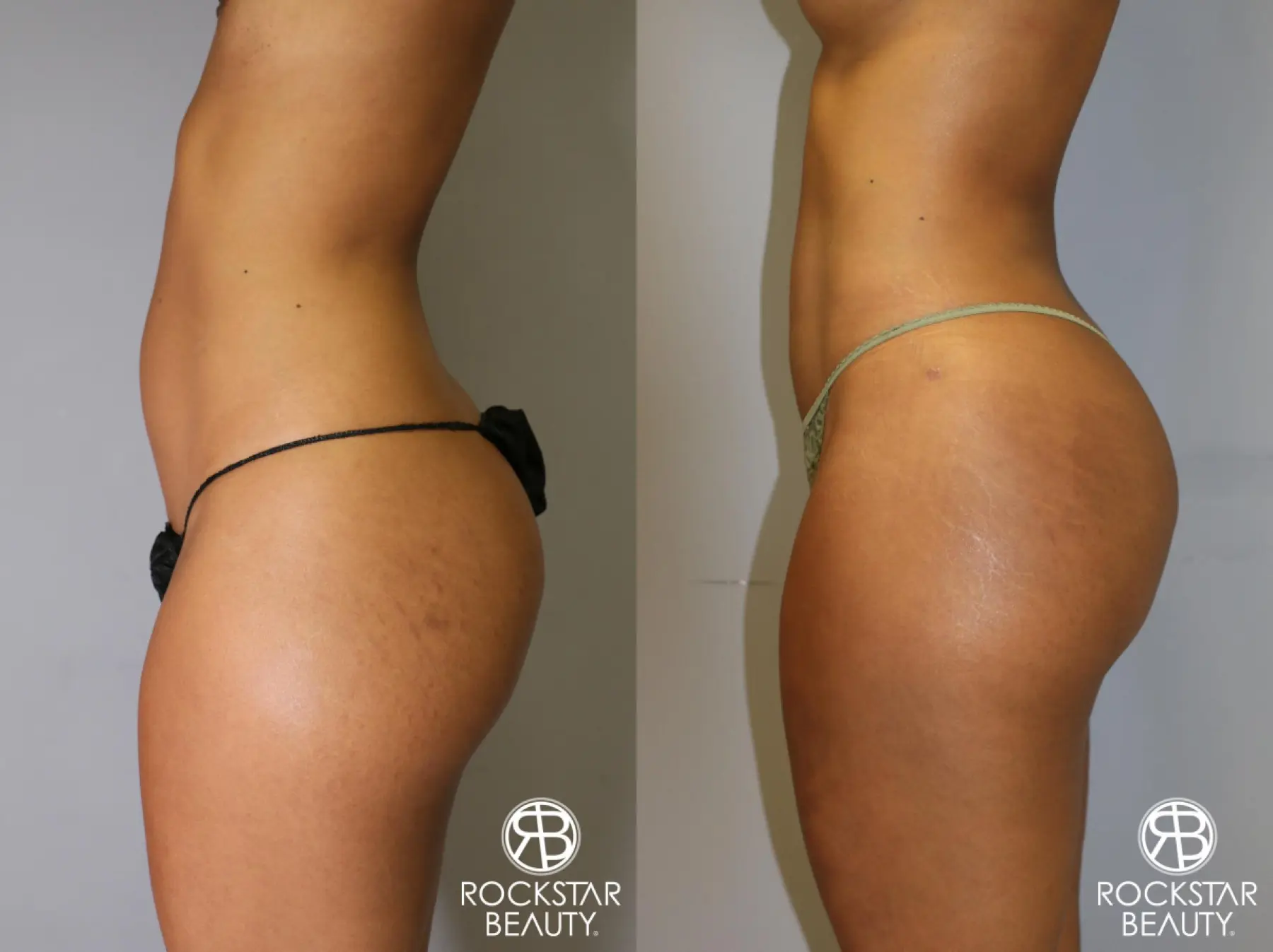 Brazilian Butt Lift: Patient 8 - Before and After 3