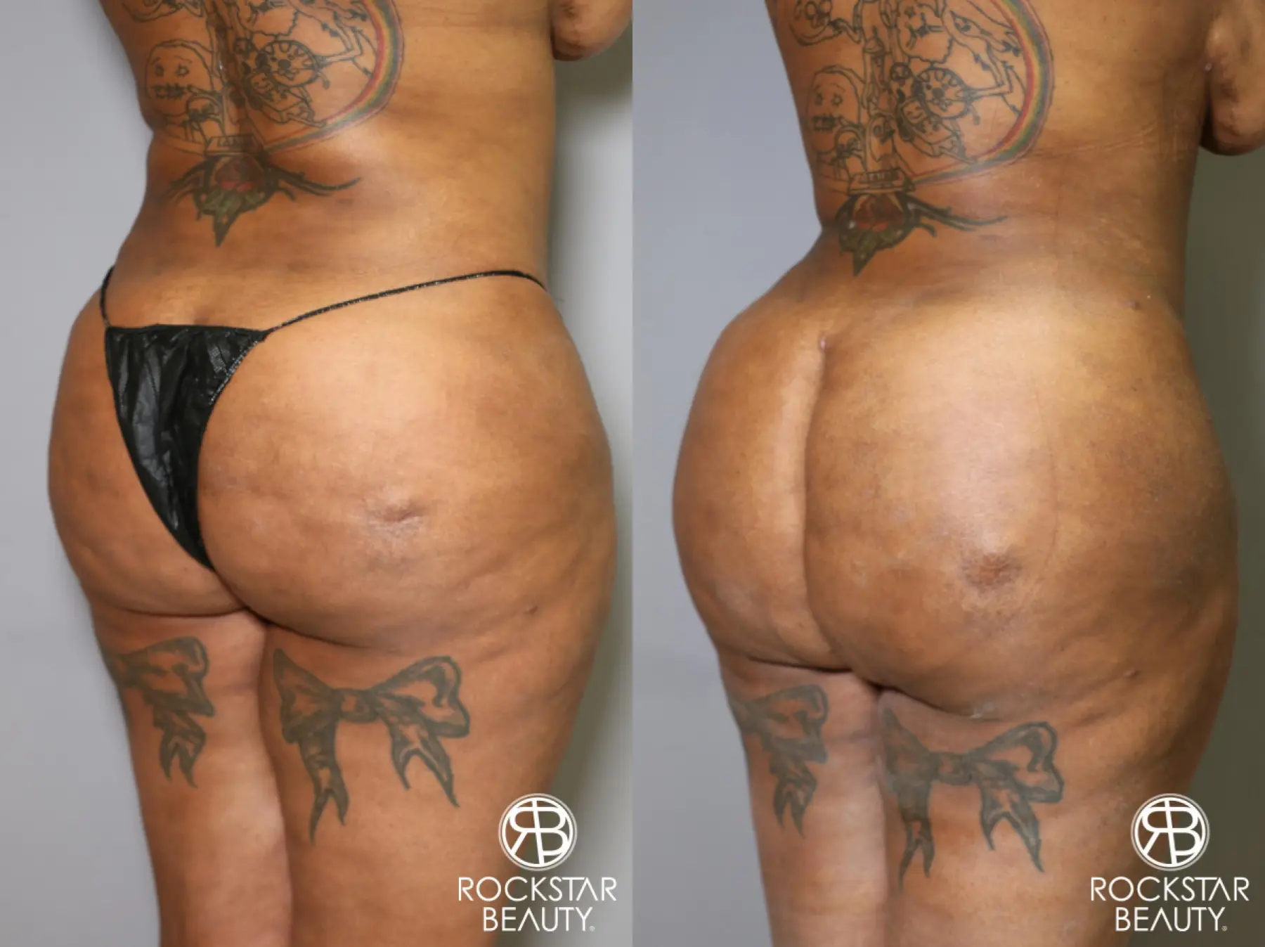 Brazilian Butt Lift: Patient 15 - Before and After 2