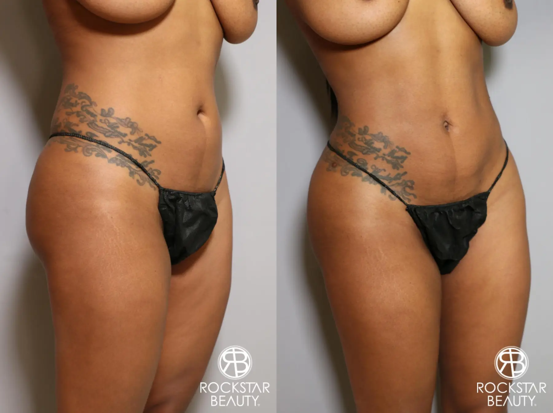 Brazilian Butt Lift: Patient 10 - Before and After 4
