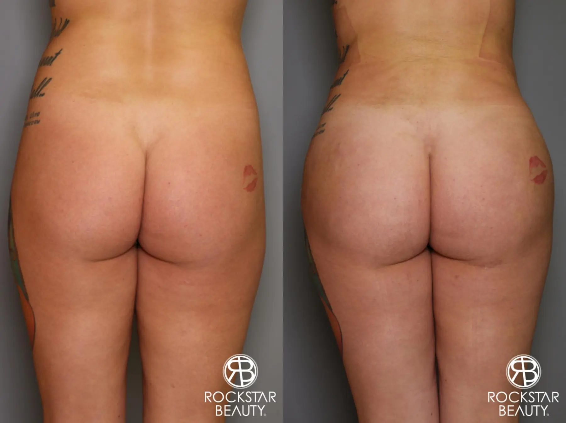 Brazilian Butt Lift: Patient 17 - Before and After 1