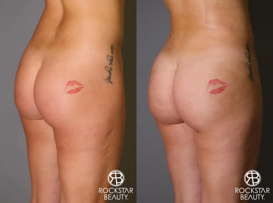 Brazilian Butt Lift: Patient 17 - Before and After 2