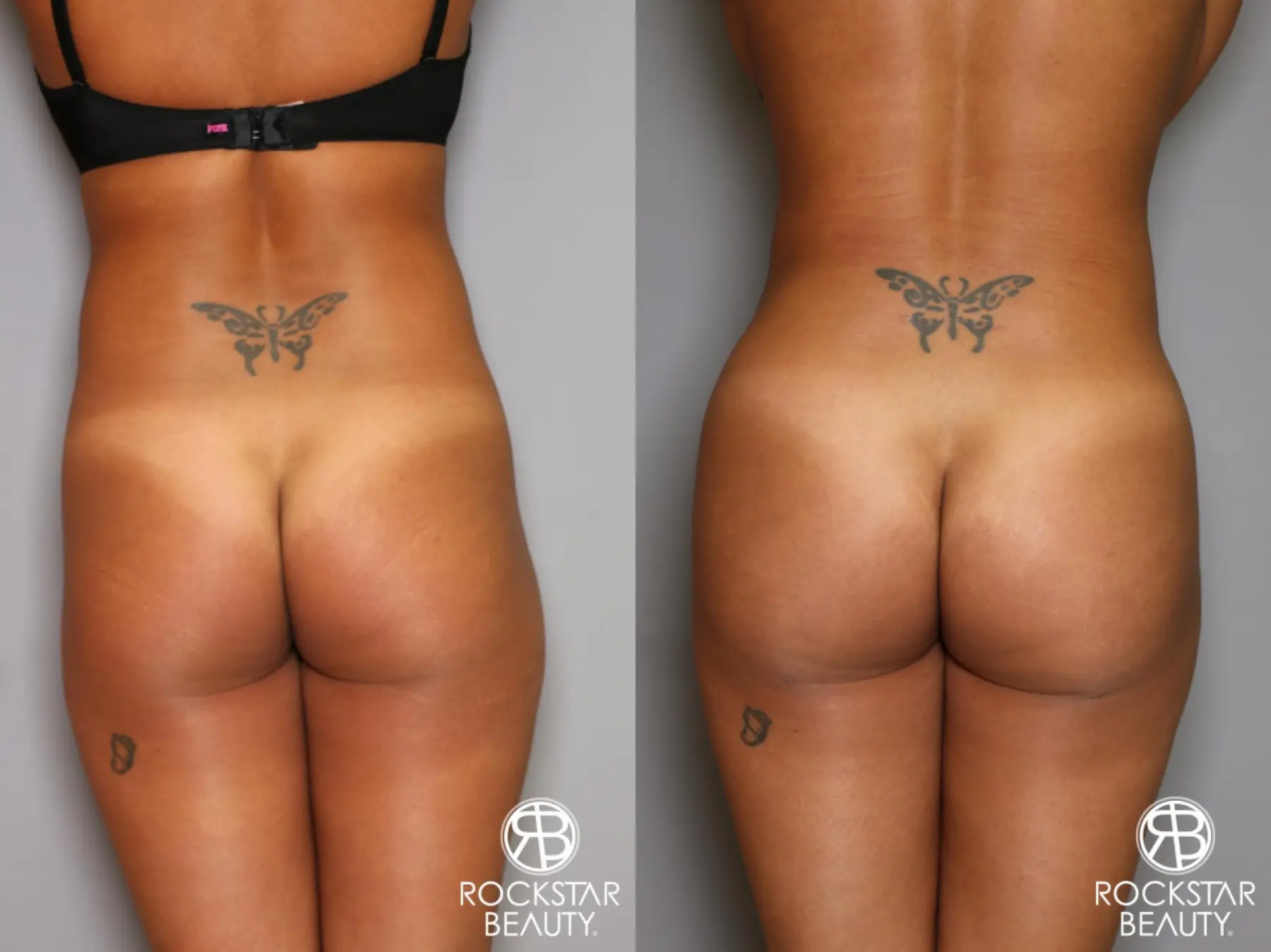 Brazilian Butt Lift: Patient 9 - Before and After 1