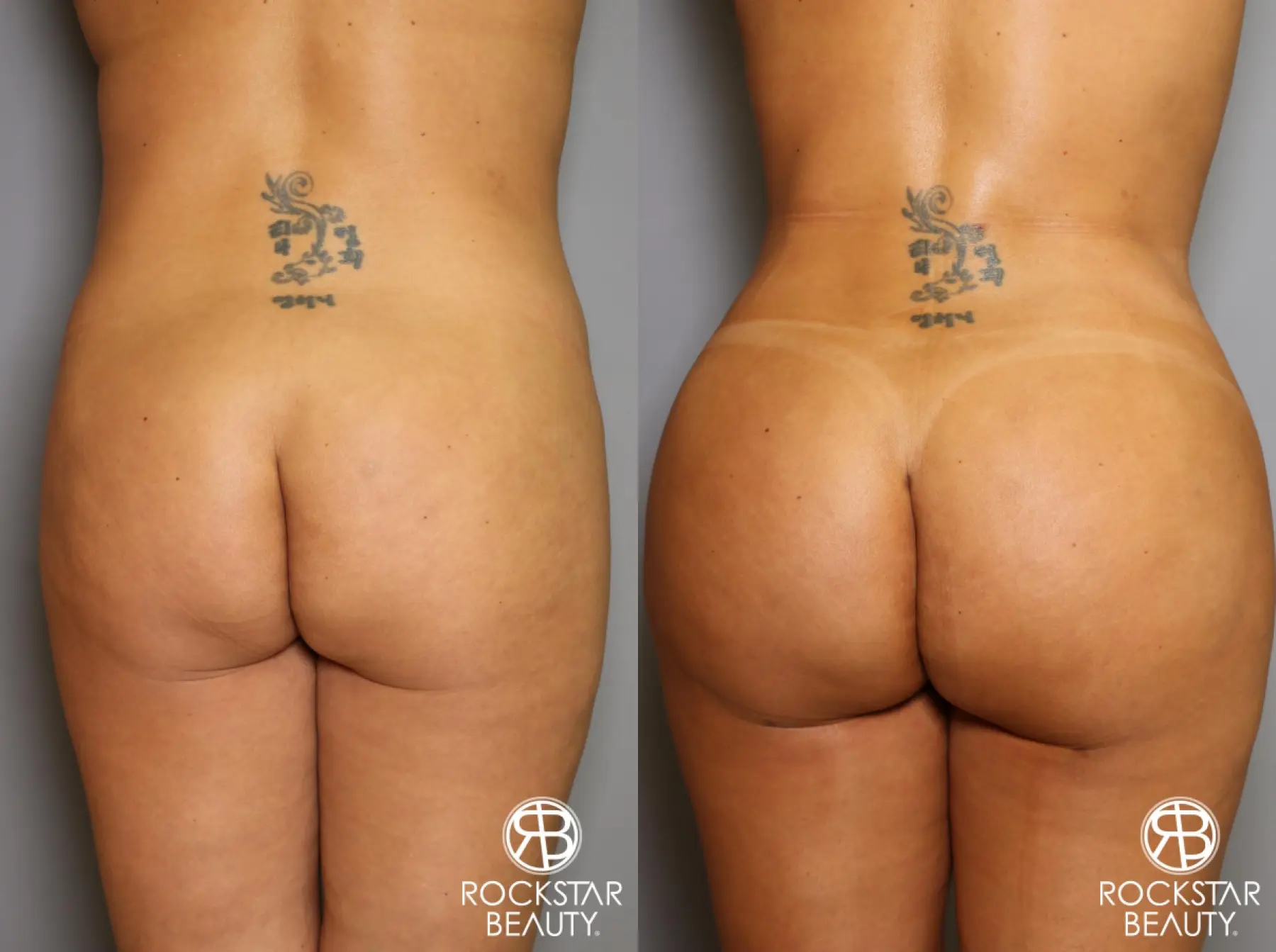 Brazilian Butt Lift: Patient 12 - Before and After 1