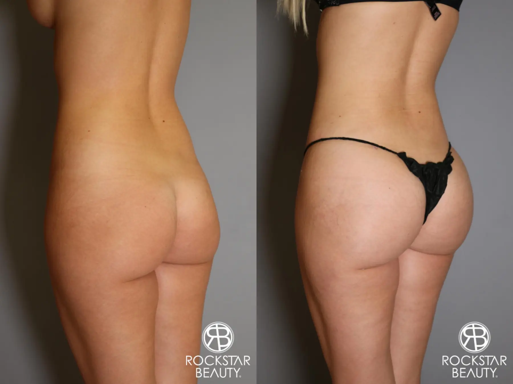 Brazilian Butt Lift: Patient 2 - Before and After 3