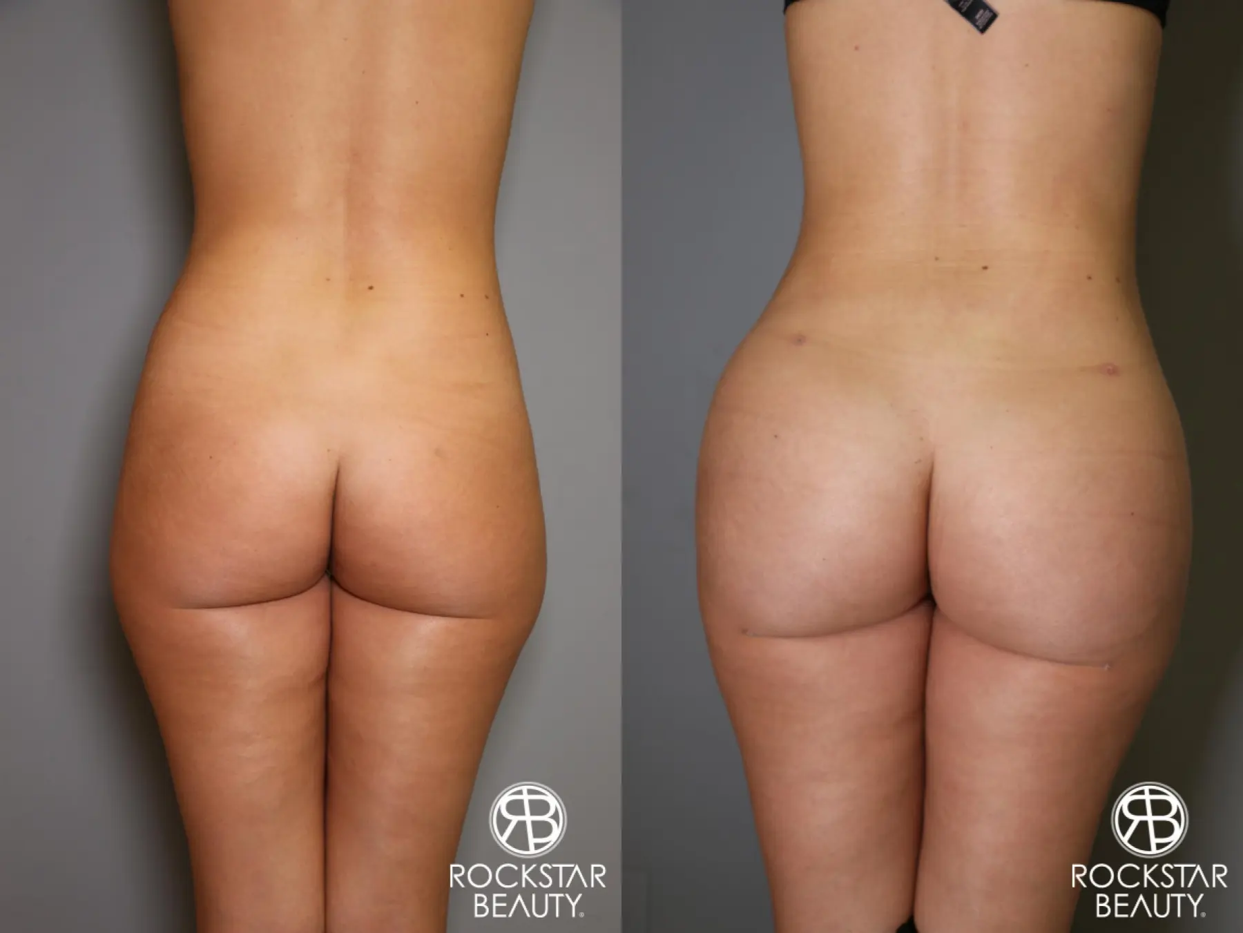 Brazilian Butt Lift: Patient 2 - Before and After  