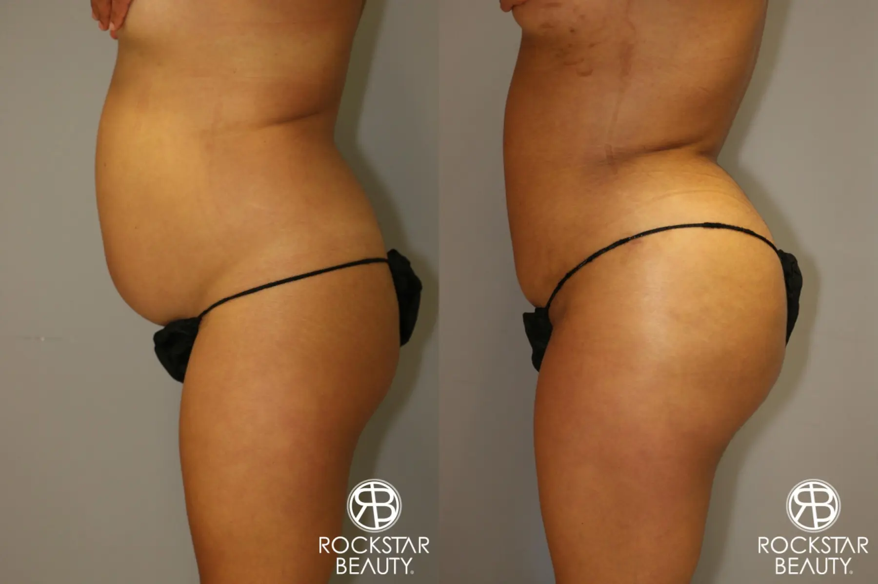 Brazilian Butt Lift: Patient 1 - Before and After 4