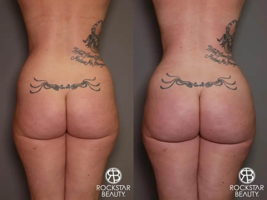 Brazilian Butt Lift: Patient 7 - Before and After 1