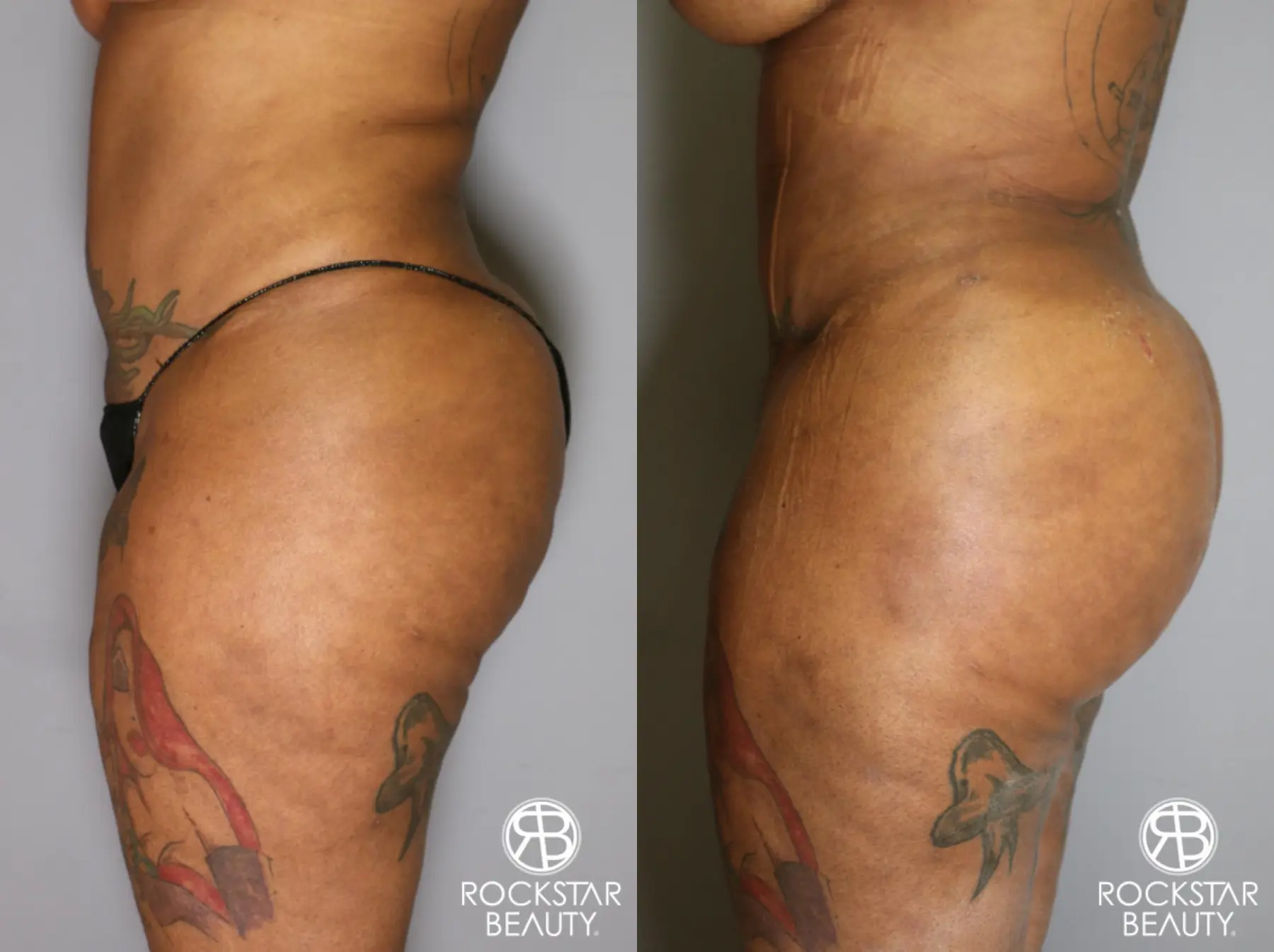Brazilian Butt Lift: Patient 15 - Before and After 4