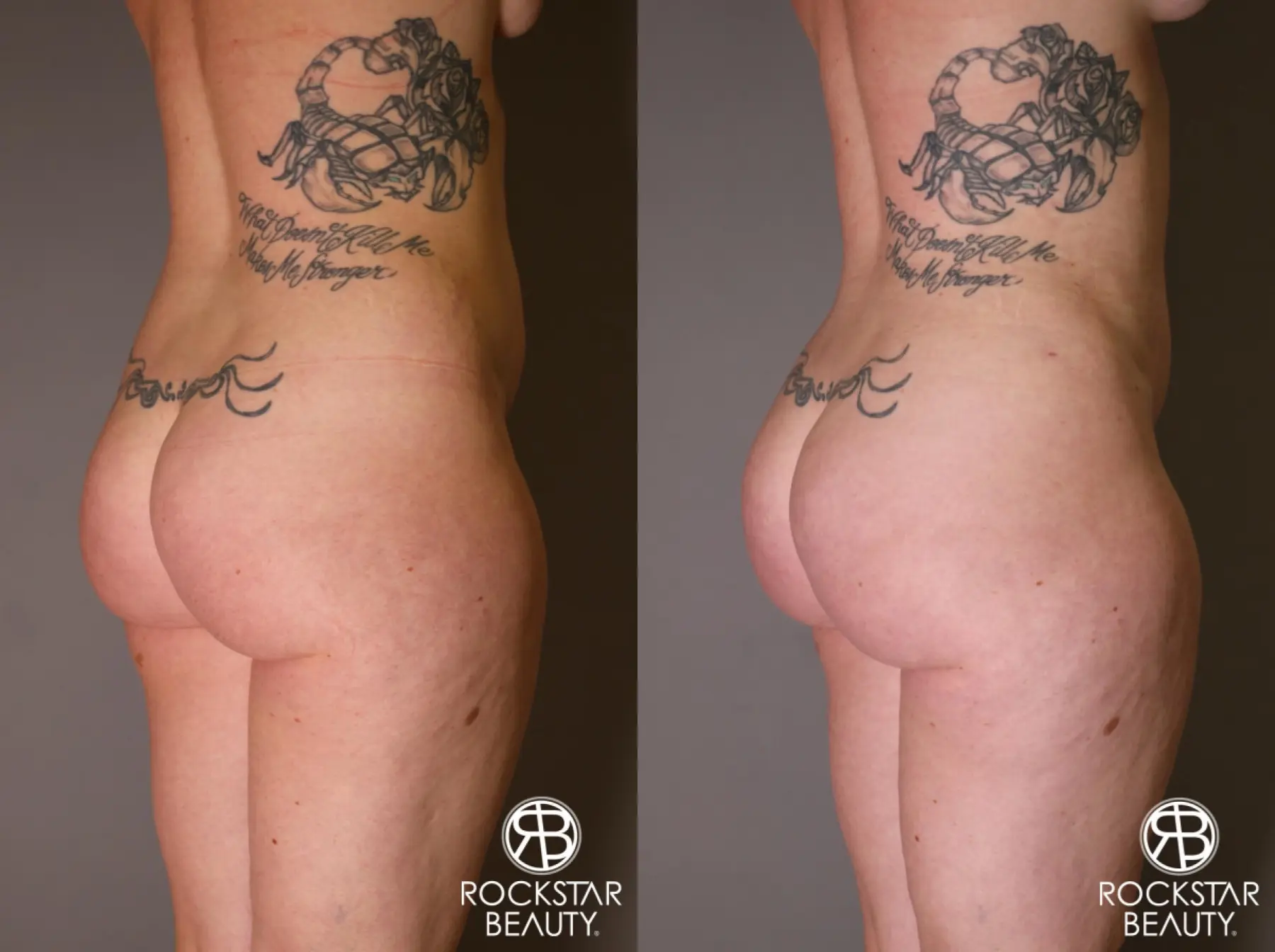 Brazilian Butt Lift: Patient 7 - Before and After 2