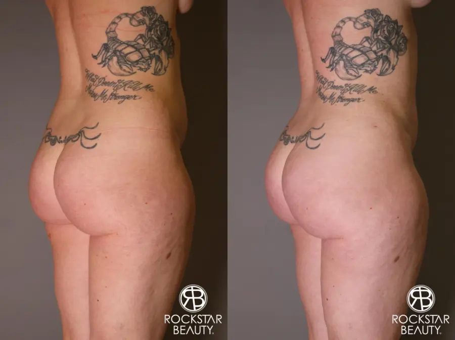 Brazilian Butt Lift: Patient 7 - Before and After 2
