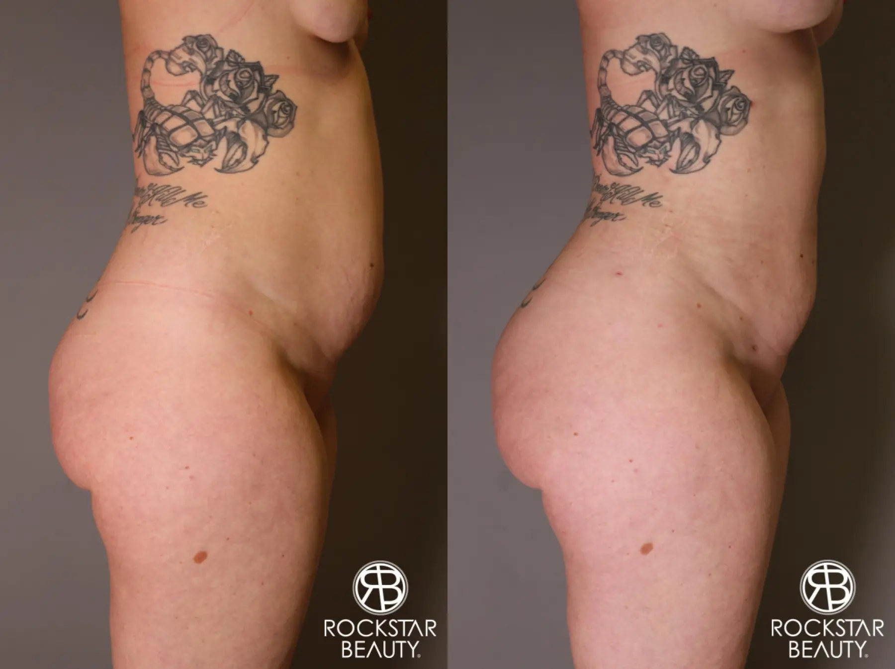 Brazilian Butt Lift: Patient 7 - Before and After 3