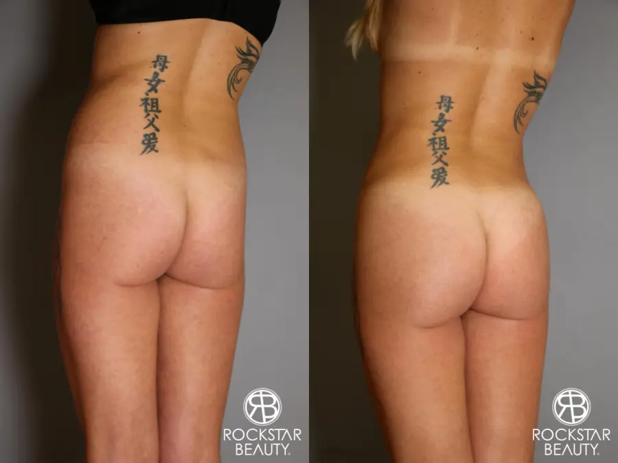 Brazilian Butt Lift: Patient 6 - Before and After 3