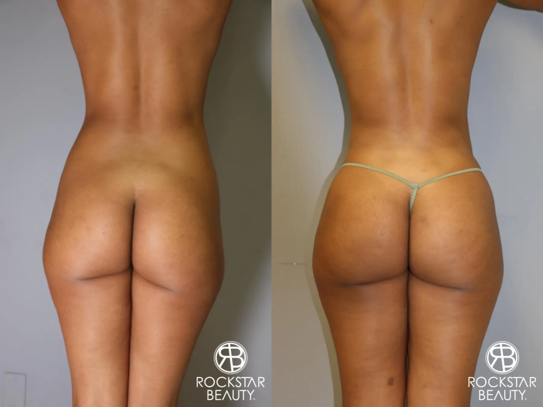 Brazilian Butt Lift: Patient 8 - Before and After 1