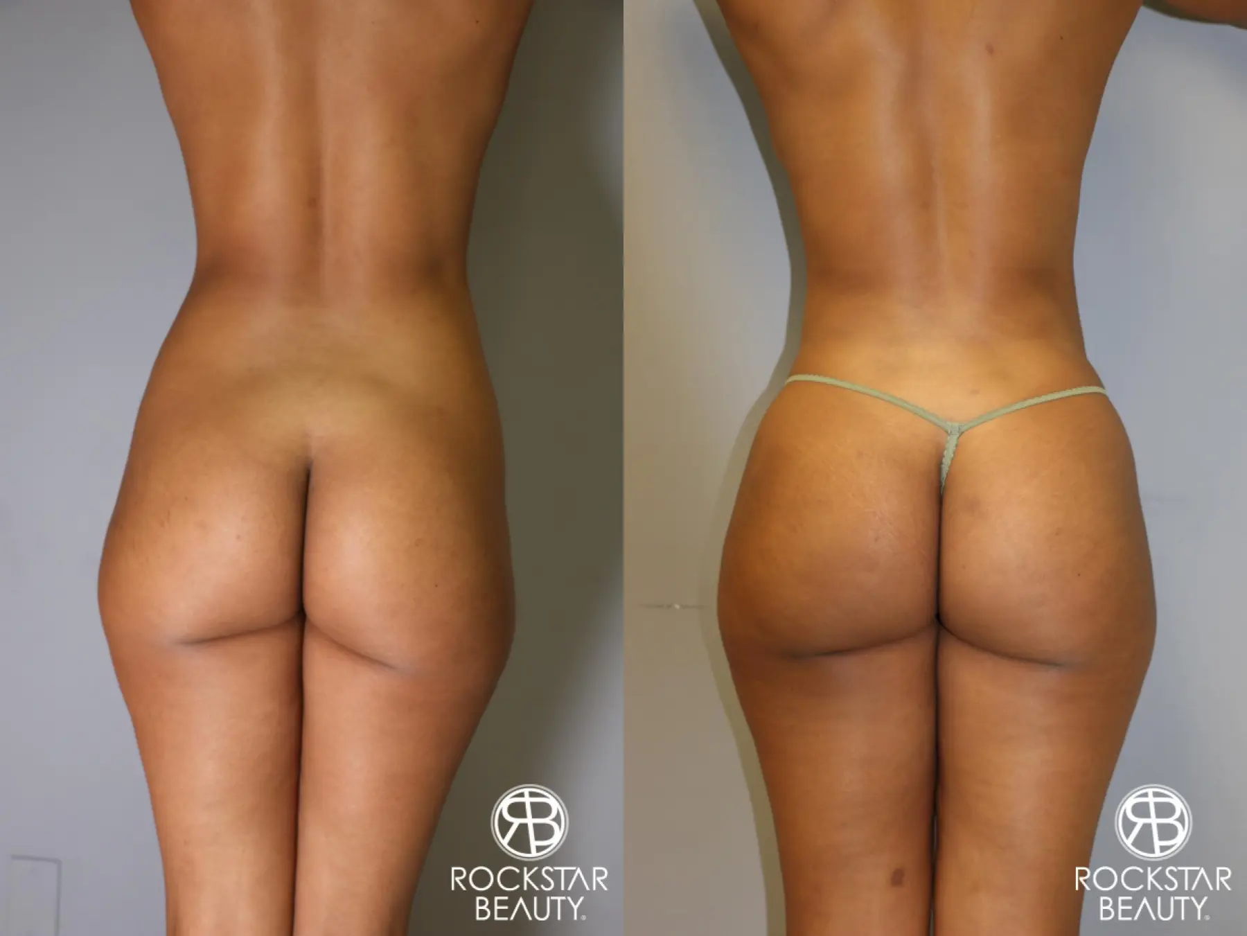 Brazilian Butt Lift: Patient 8 - Before and After  