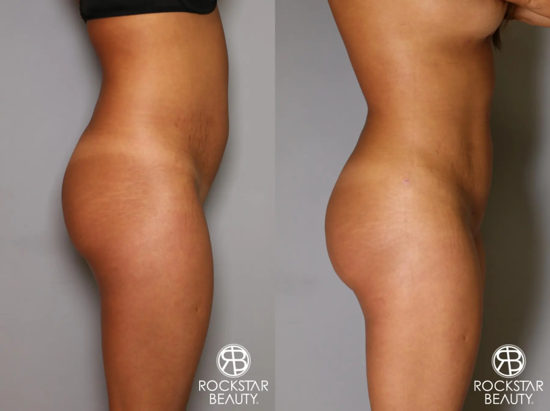 Brazilian Butt Lift: Patient 9 - Before and After 2