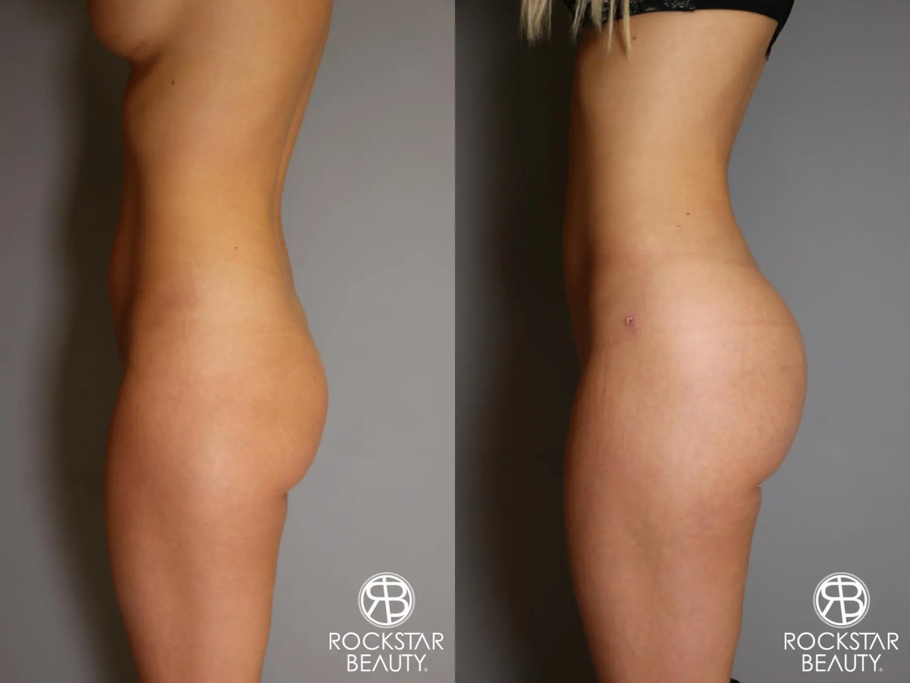 Brazilian Butt Lift: Patient 2 - Before and After 2