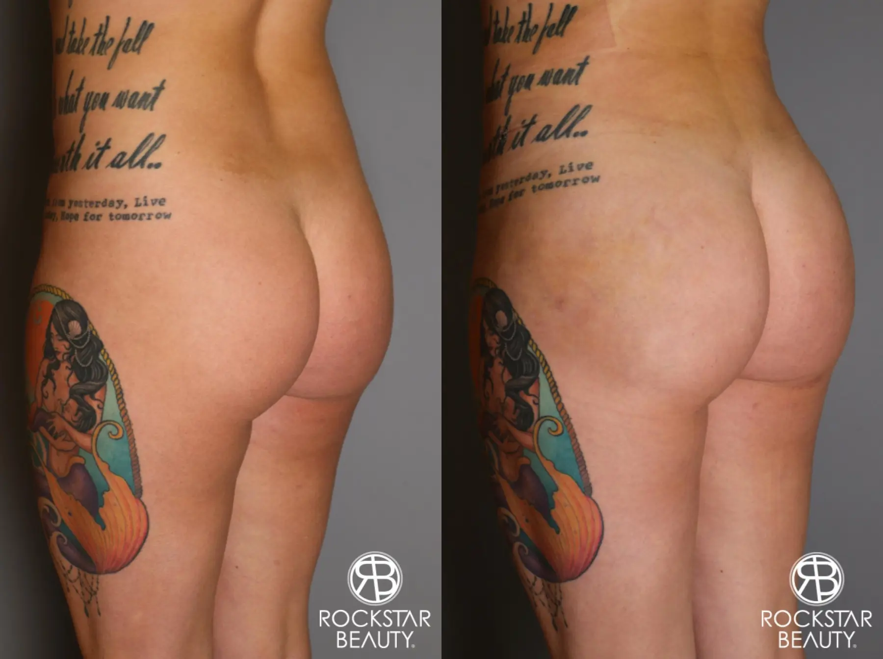 Brazilian Butt Lift: Patient 17 - Before and After 3