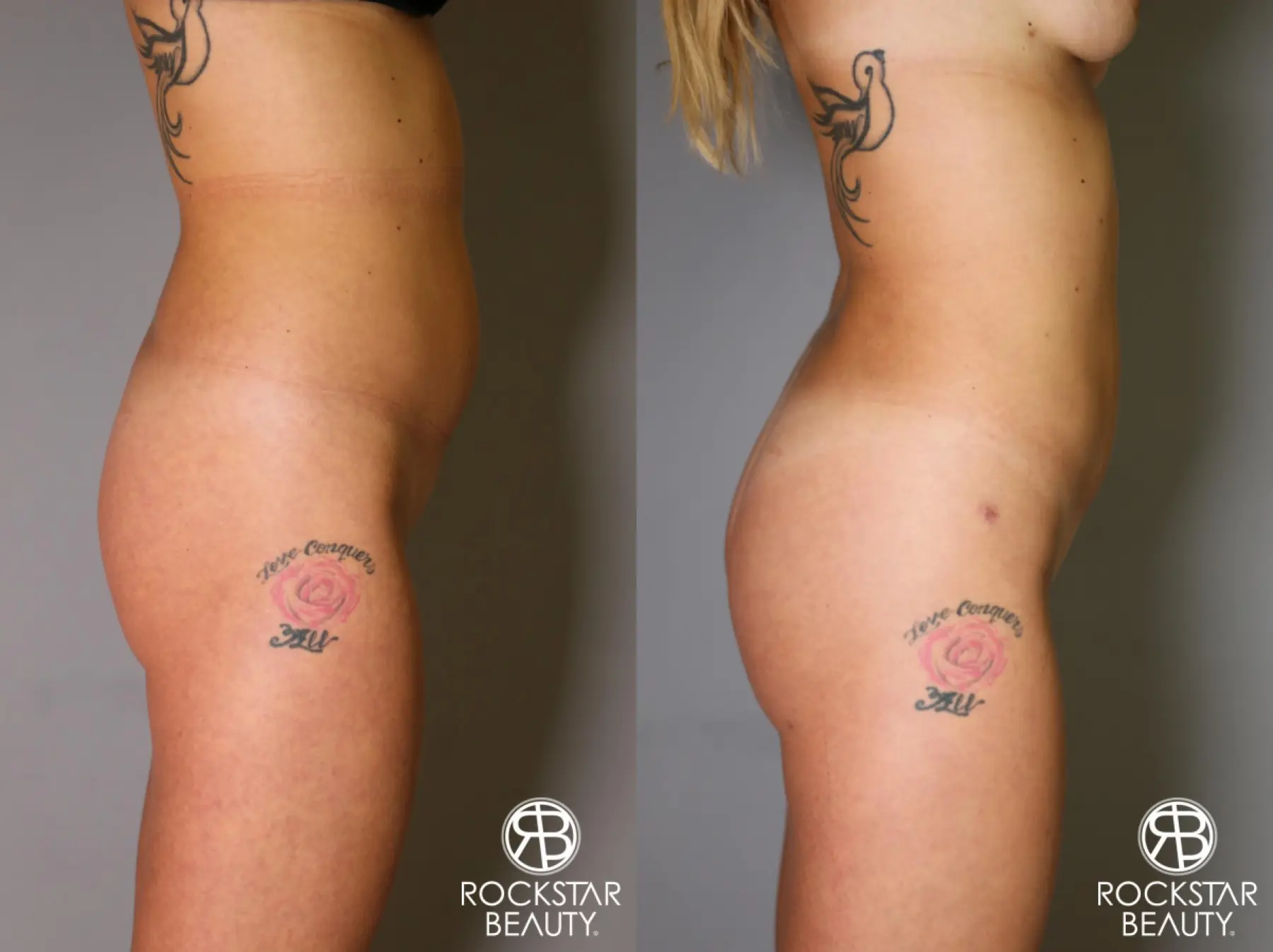 Brazilian Butt Lift: Patient 6 - Before and After 4