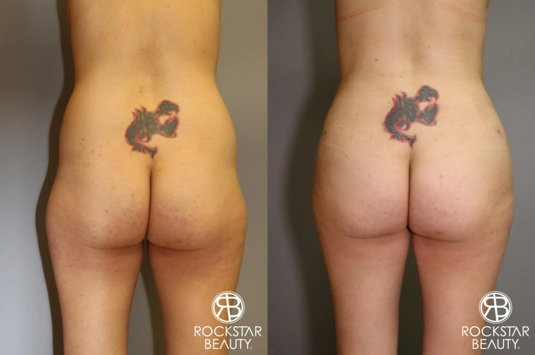 Brazilian Butt Lift: Patient 4 - Before and After  