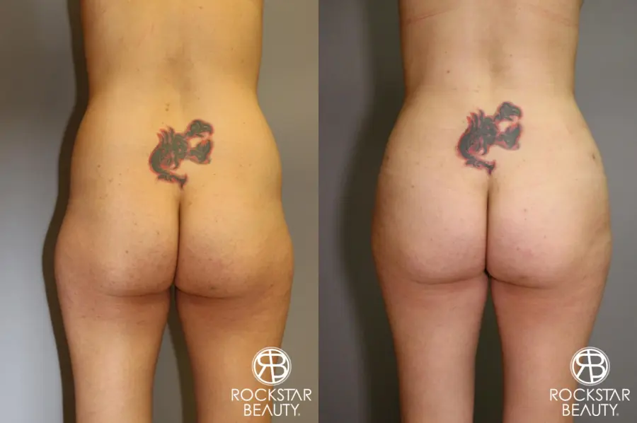 Brazilian Butt Lift: Patient 4 - Before and After 1