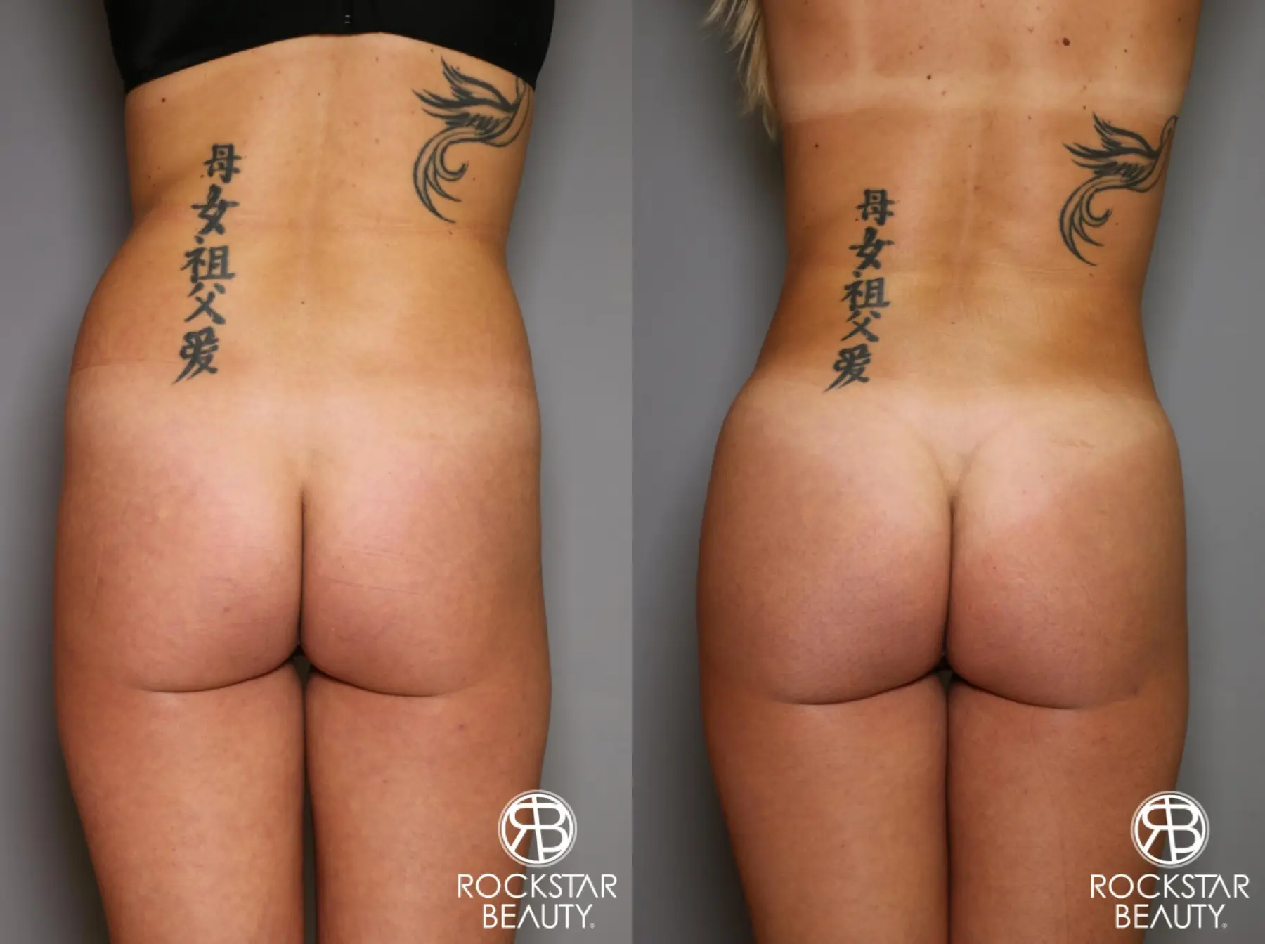 Brazilian Butt Lift: Patient 6 - Before and After  