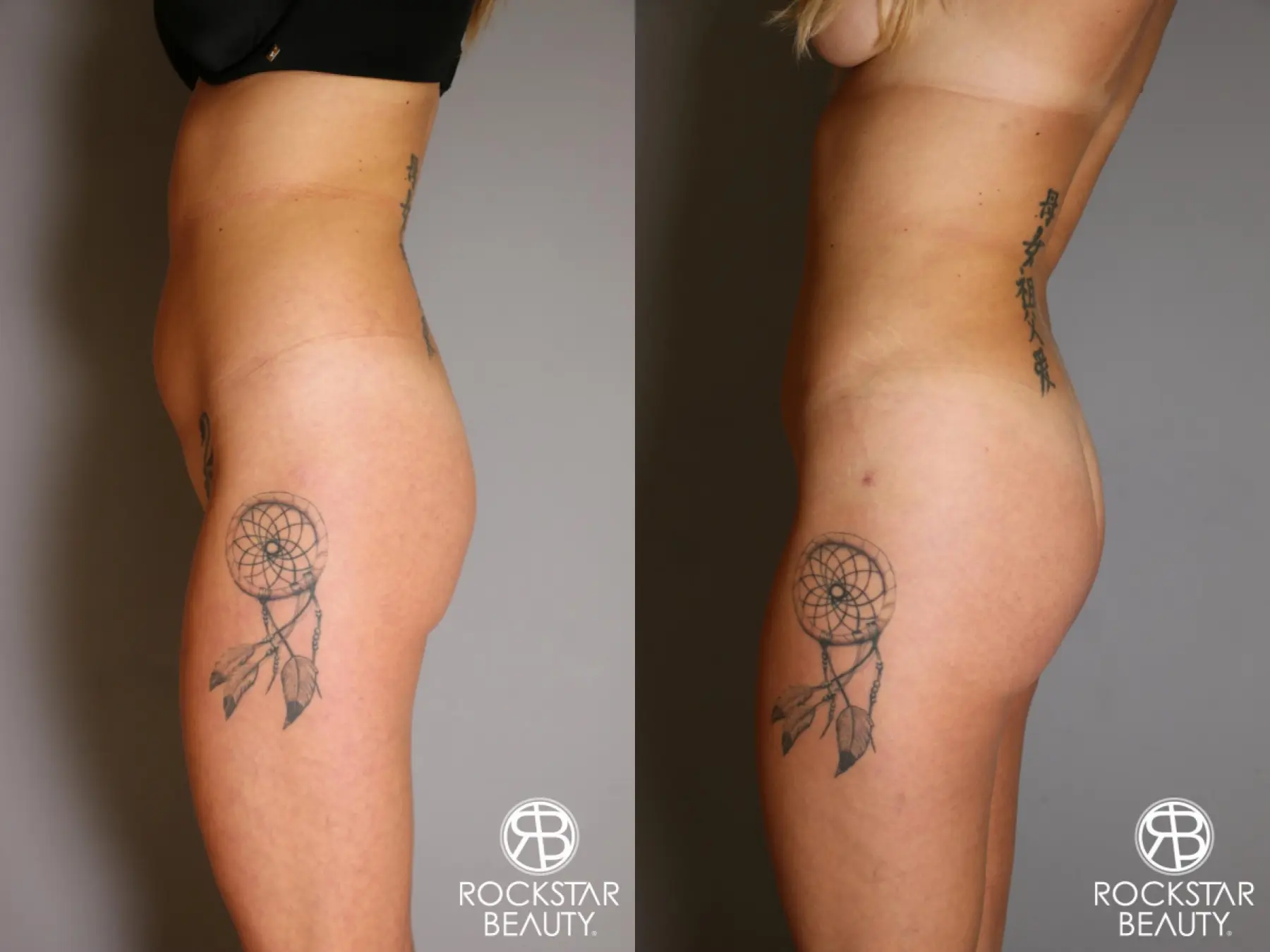 Brazilian Butt Lift: Patient 6 - Before and After 5