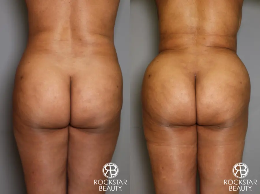 Brazilian Butt Lift: Patient 11 - Before and After 1