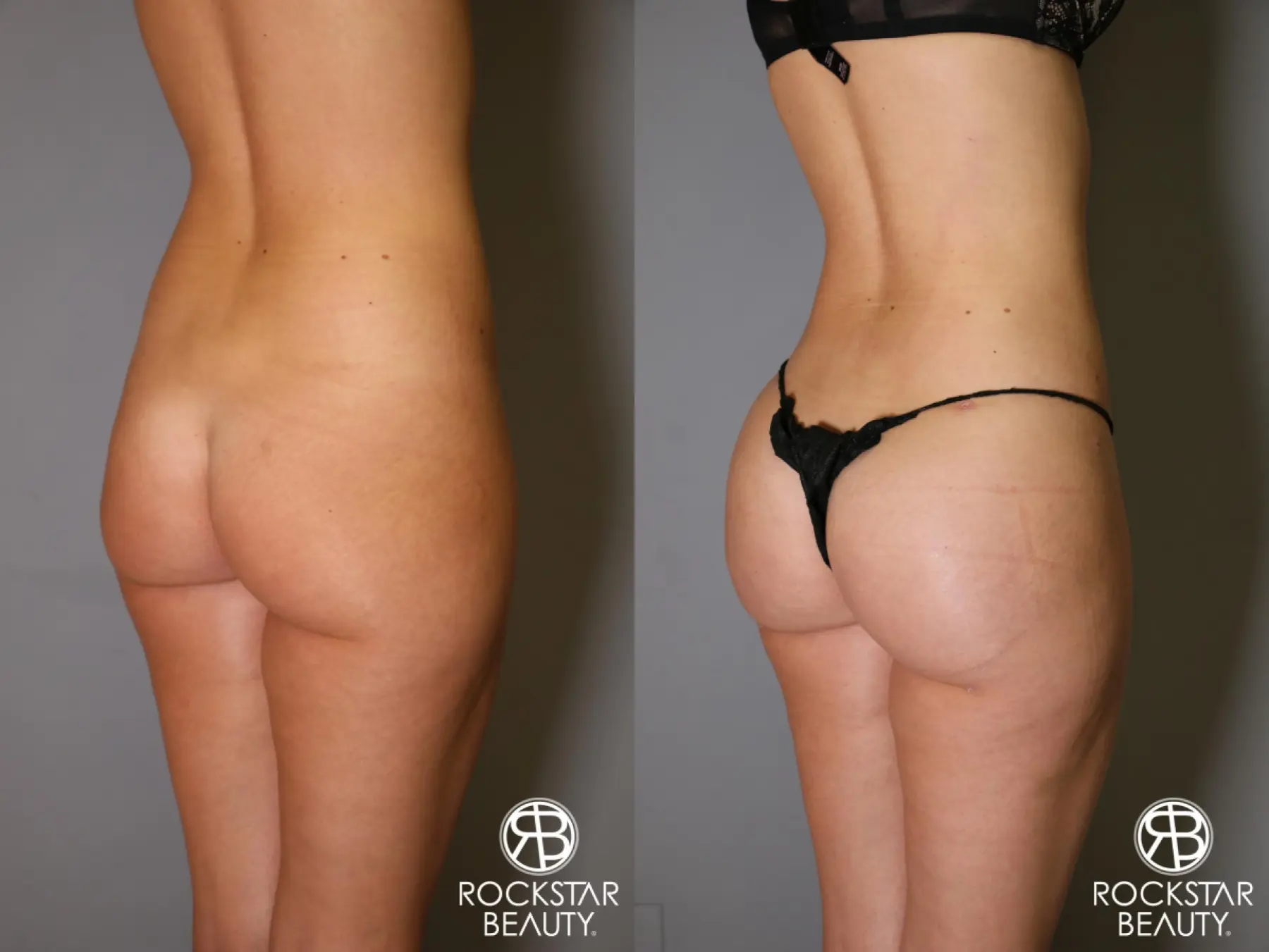Brazilian Butt Lift: Patient 2 - Before and After 4