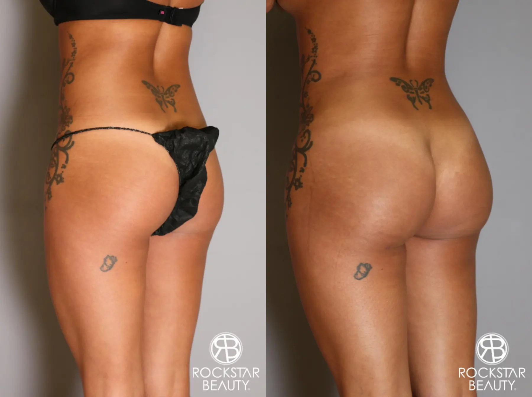 Brazilian Butt Lift: Patient 9 - Before and After 4
