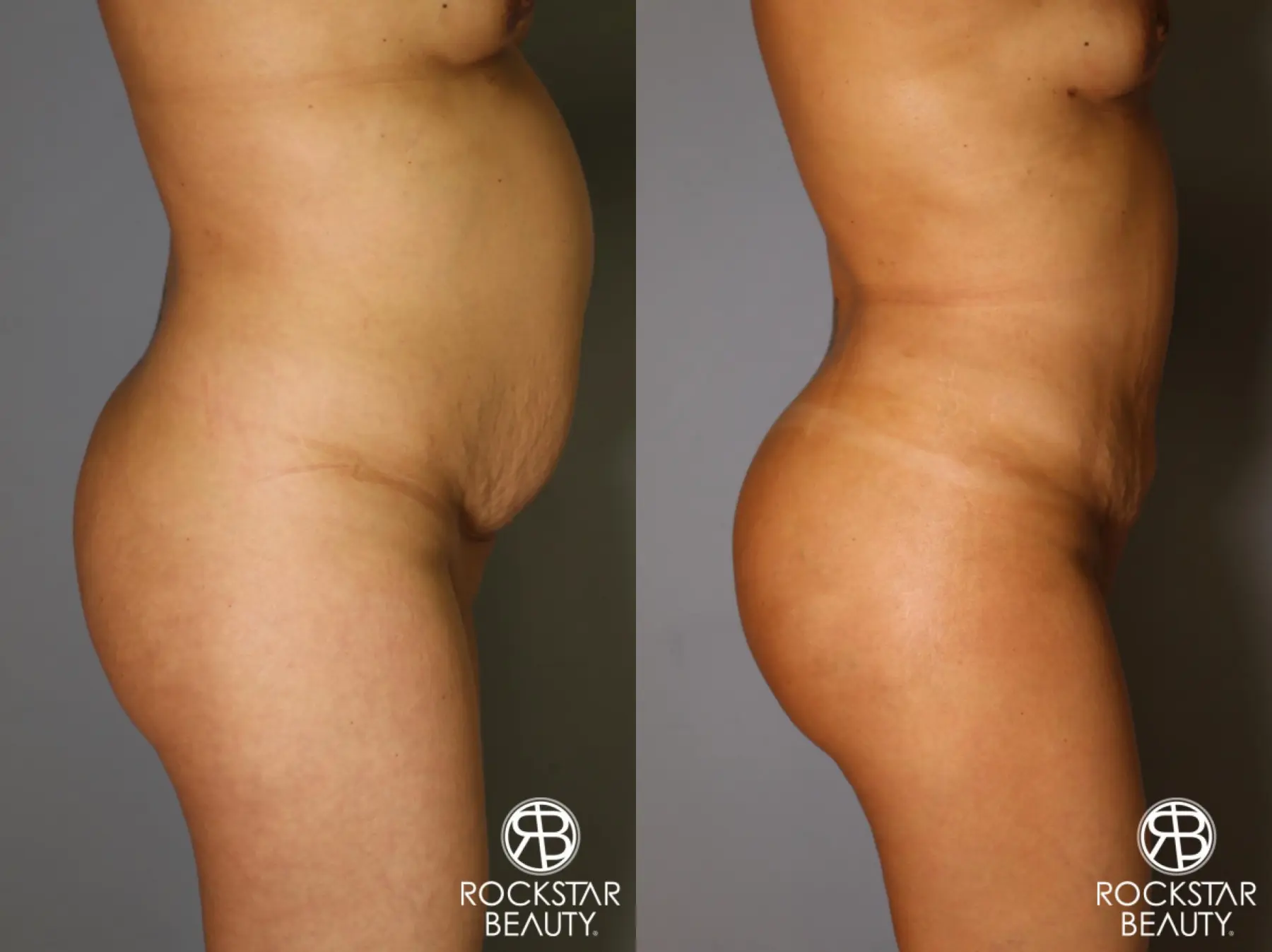 Brazilian Butt Lift: Patient 12 - Before and After 3