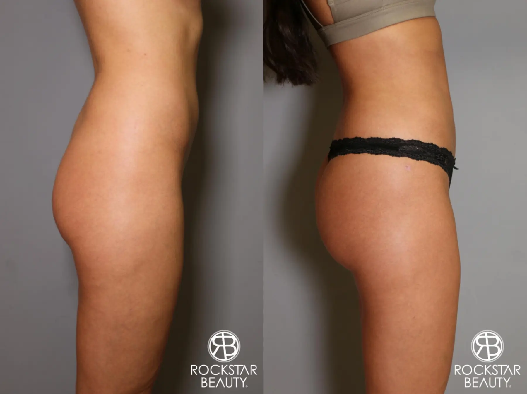 Brazilian Butt Lift: Patient 5 - Before and After 3