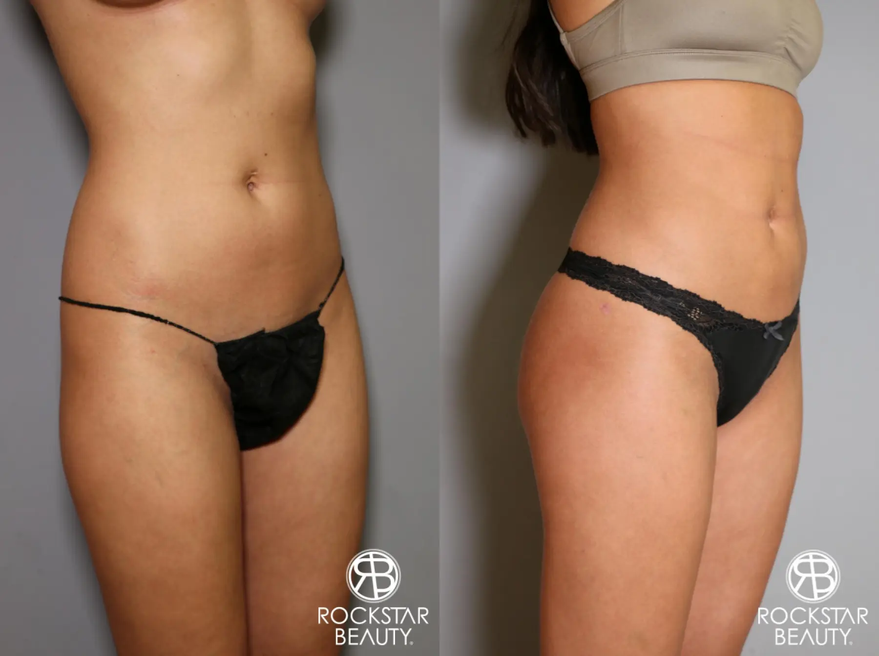 Brazilian Butt Lift: Patient 5 - Before and After 5