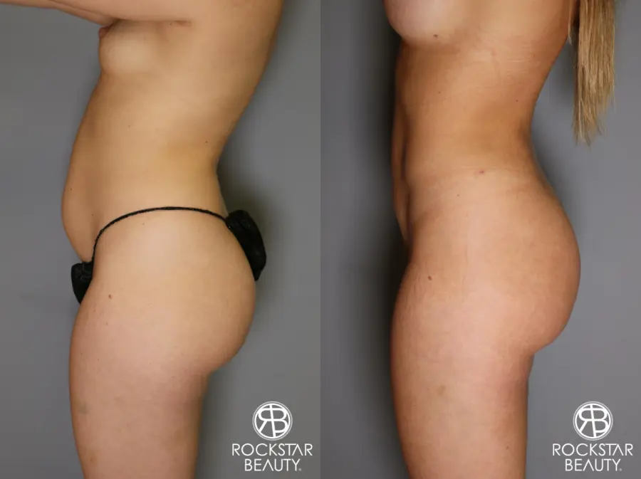 Brazilian Butt Lift: Patient 16 - Before and After 2