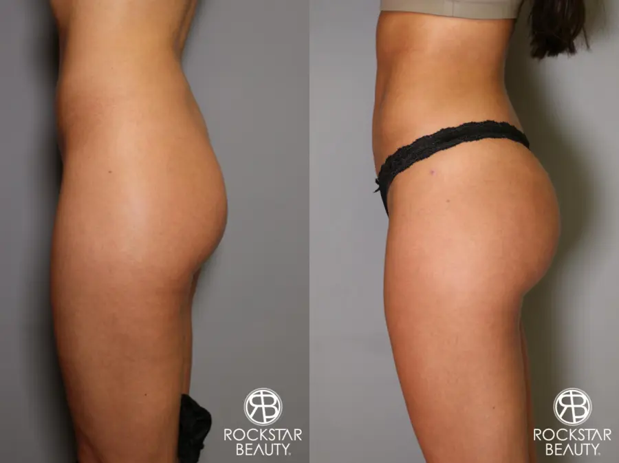 Brazilian Butt Lift: Patient 5 - Before and After 2