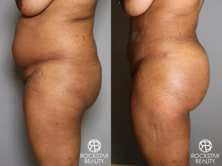 Brazilian Butt Lift: Patient 13 - Before and After 3