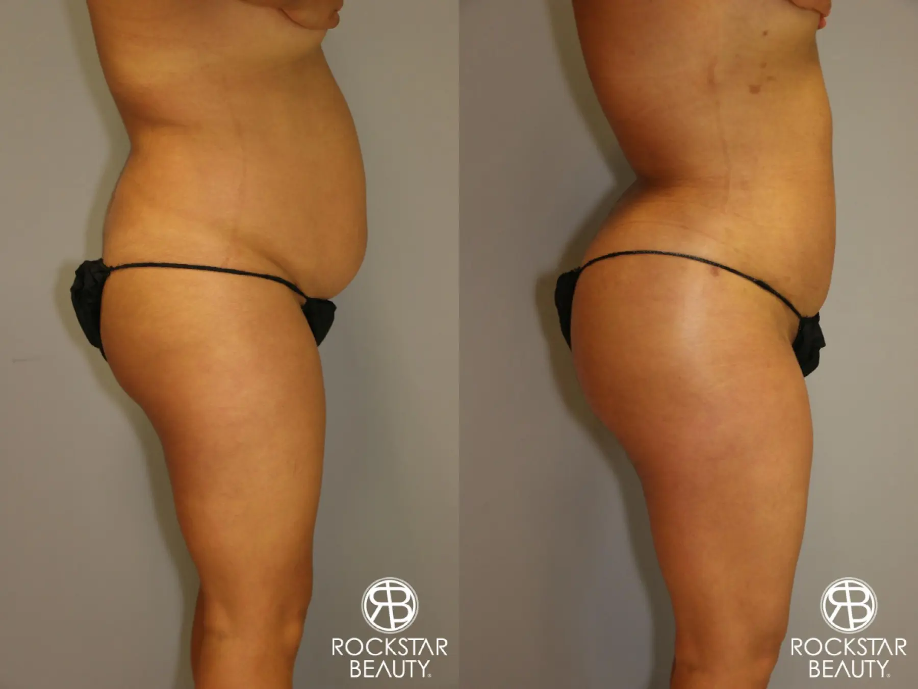 Brazilian Butt Lift: Patient 1 - Before and After 3