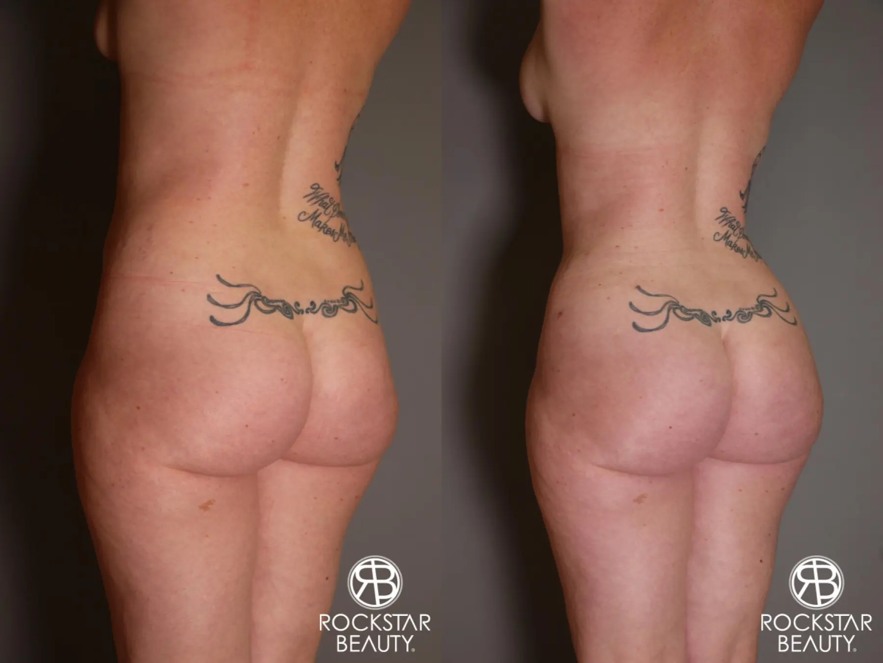 Brazilian Butt Lift: Patient 7 - Before and After 4