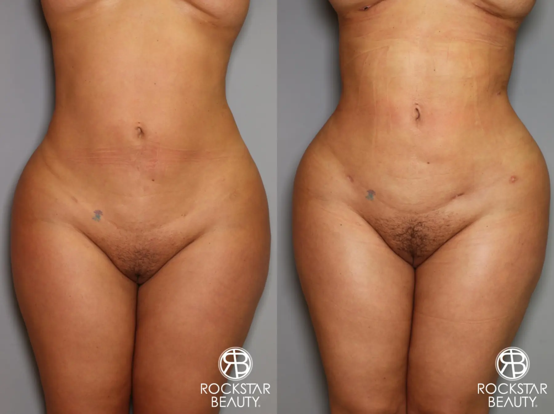 Brazilian Butt Lift: Patient 14 - Before and After 2