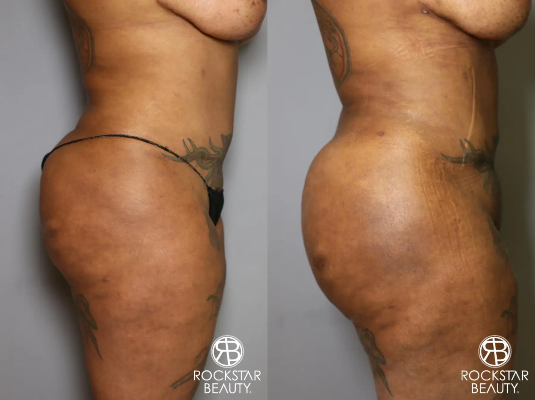 Brazilian Butt Lift: Patient 15 - Before and After 5