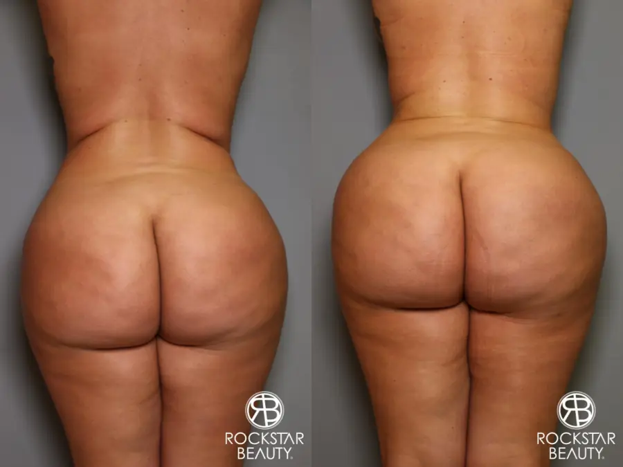 Brazilian Butt Lift: Patient 14 - Before and After 1