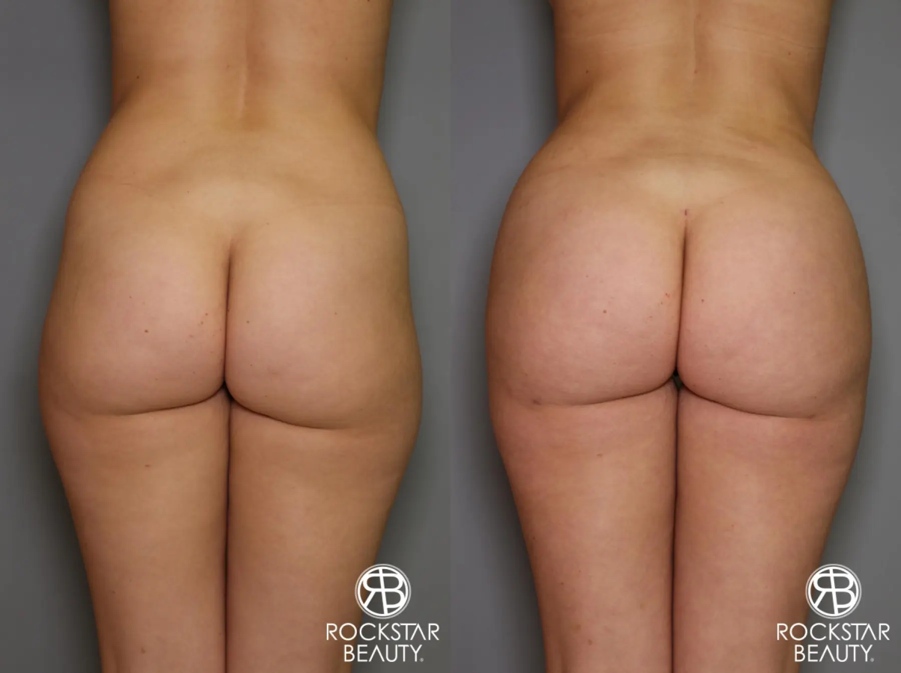Brazilian Butt Lift: Patient 18 - Before and After 1
